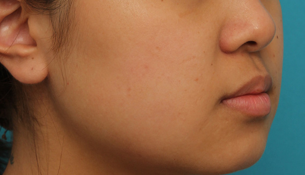 鼻翼縮小（小鼻縮小）,小鼻縮小の症例写真,1ヶ月後,mainpic_biyoku048n.jpg