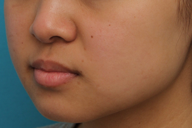 鼻翼縮小（小鼻縮小）,小鼻縮小の症例写真,手術前,mainpic_biyoku048p.jpg
