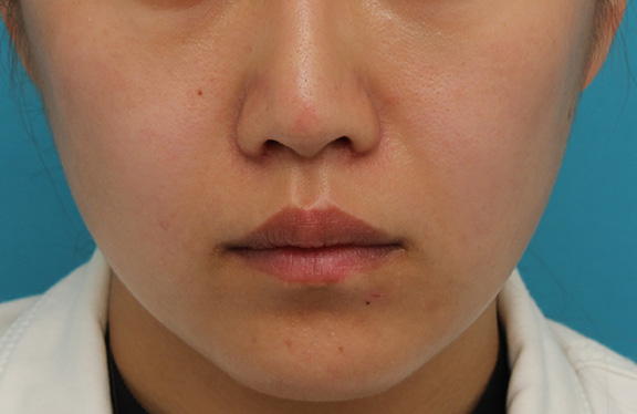 鼻翼縮小（小鼻縮小）,鼻翼縮小と鼻先への耳介軟骨移植の同時手術を行った症例写真,After（2ヶ月後）,ba_biyoku049_b01.jpg