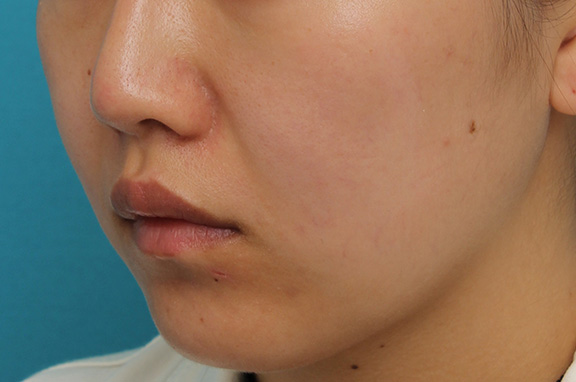 耳介軟骨移植（鼻先を出す）,鼻翼縮小と鼻先への耳介軟骨移植の同時手術を行った症例写真,After（2ヶ月後）,ba_biyoku049_b02.jpg