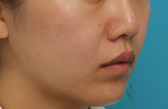 耳介軟骨移植（鼻先を出す）,鼻翼縮小と鼻先への耳介軟骨移植の同時手術を行った症例写真,After（2ヶ月後）,ba_biyoku049_b03.jpg