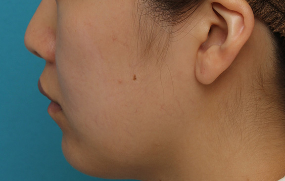 鼻翼縮小（小鼻縮小）,鼻翼縮小と鼻先への耳介軟骨移植の同時手術を行った症例写真,After（2ヶ月後）,ba_biyoku049_b04.jpg
