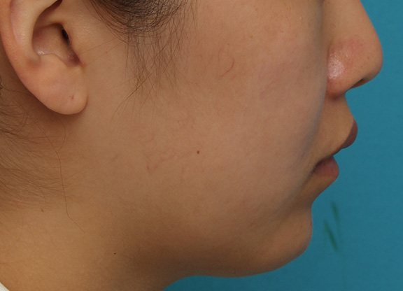 耳介軟骨移植（鼻先を出す）,鼻翼縮小と鼻先への耳介軟骨移植の同時手術を行った症例写真,After（2ヶ月後）,ba_biyoku049_b05.jpg