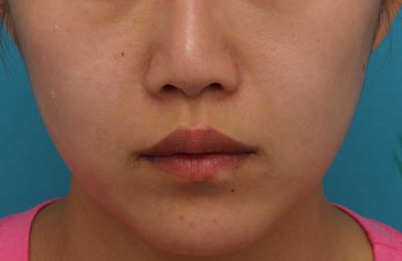 耳介軟骨移植（鼻先を出す）,鼻翼縮小と鼻先への耳介軟骨移植の同時手術を行った症例写真,Before,ba_biyoku049_b01.jpg