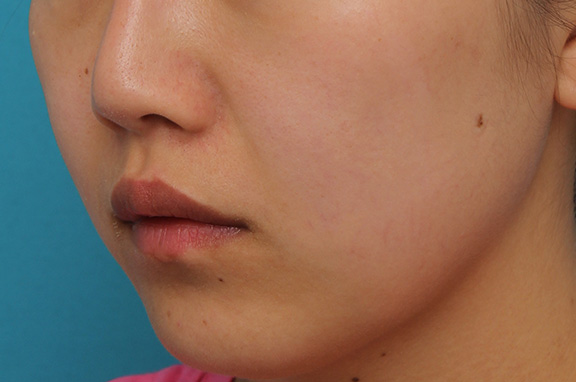 耳介軟骨移植（鼻先を出す）,鼻翼縮小と鼻先への耳介軟骨移植の同時手術を行った症例写真,Before,ba_biyoku049_b02.jpg