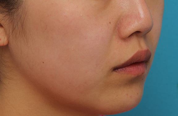耳介軟骨移植（鼻先を出す）,鼻翼縮小と鼻先への耳介軟骨移植の同時手術を行った症例写真,Before,ba_biyoku049_b03.jpg