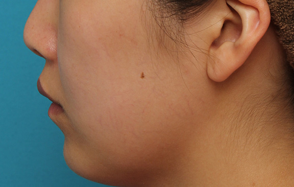 耳介軟骨移植（鼻先を出す）,鼻翼縮小と鼻先への耳介軟骨移植の同時手術を行った症例写真,Before,ba_biyoku049_b04.jpg