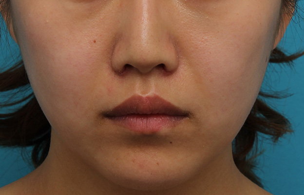 鼻翼縮小（小鼻縮小）,鼻翼縮小と鼻先への耳介軟骨移植の同時手術を行った症例写真,1週間後（抜糸時）,mainpic_biyoku049c.jpg