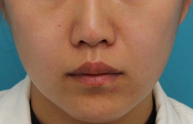 鼻翼縮小（小鼻縮小）,鼻翼縮小と鼻先への耳介軟骨移植の同時手術を行った症例写真,約2ヶ月後,mainpic_biyoku049d.jpg