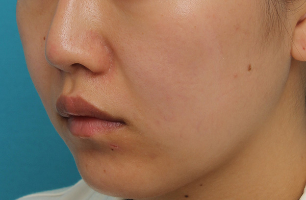鼻翼縮小（小鼻縮小）,鼻翼縮小と鼻先への耳介軟骨移植の同時手術を行った症例写真,約2ヶ月後,mainpic_biyoku049h.jpg