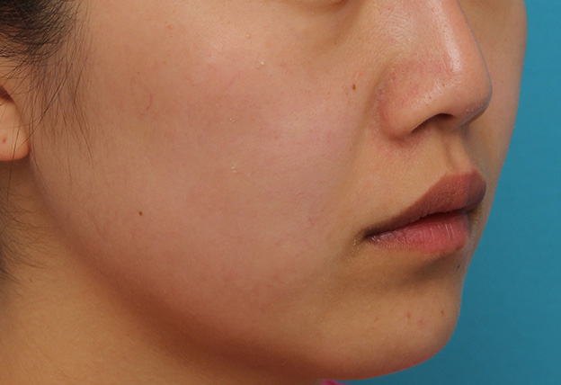 鼻翼縮小（小鼻縮小）,鼻翼縮小と鼻先への耳介軟骨移植の同時手術を行った症例写真,手術前,mainpic_biyoku049i.jpg