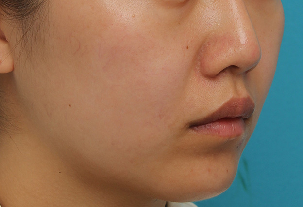 鼻翼縮小（小鼻縮小）,鼻翼縮小と鼻先への耳介軟骨移植の同時手術を行った症例写真,約2ヶ月後,mainpic_biyoku049l.jpg