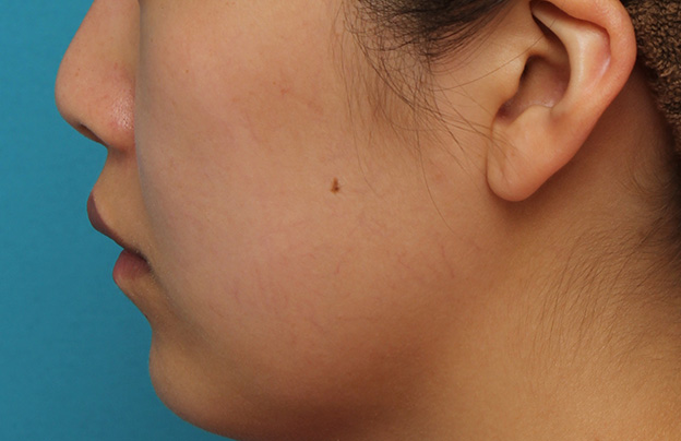 耳介軟骨移植（鼻先を出す）,鼻翼縮小と鼻先への耳介軟骨移植の同時手術を行った症例写真,手術前,mainpic_biyoku049m.jpg