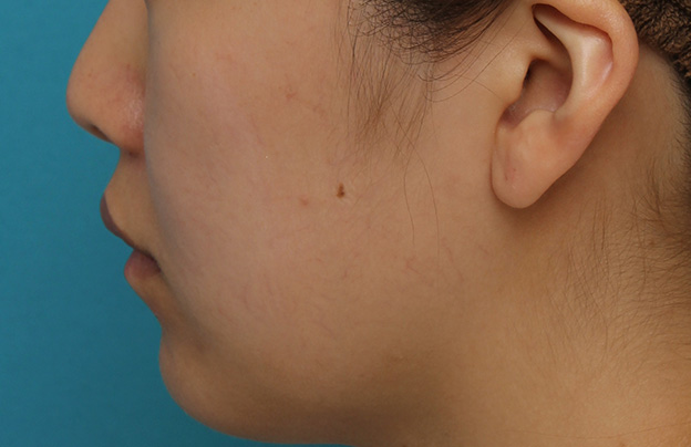 耳介軟骨移植（鼻先を出す）,鼻翼縮小と鼻先への耳介軟骨移植の同時手術を行った症例写真,約2ヶ月後,mainpic_biyoku049p.jpg