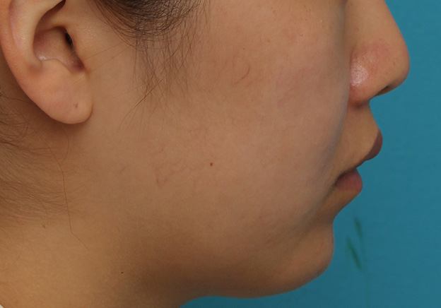 鼻翼縮小（小鼻縮小）,鼻翼縮小と鼻先への耳介軟骨移植の同時手術を行った症例写真,約2ヶ月後,mainpic_biyoku049t.jpg