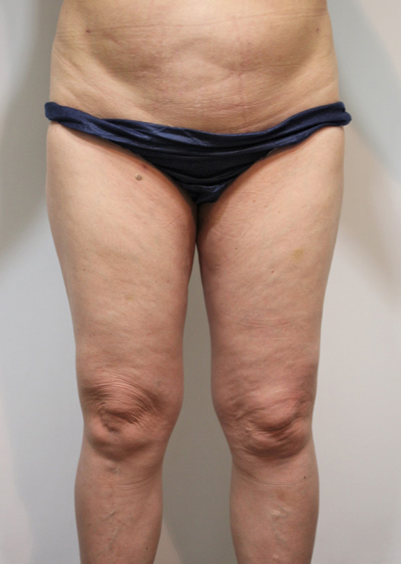 脂肪吸引,50代女性の太もも全体の脂肪吸引の症例写真,After（6ヶ月後）,ba_shibokyuin039_b01.jpg