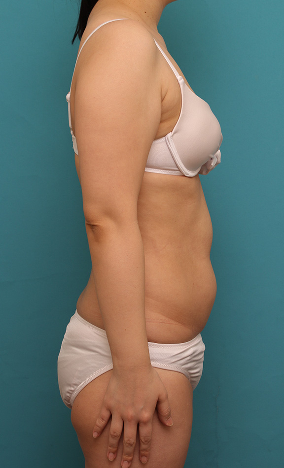 脂肪吸引,30代女性の肩から二の腕にかけて脂肪吸引を行った症例写真,Before,ba_shibokyuin040_b02.jpg