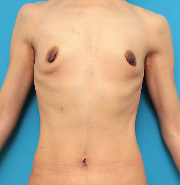 非常に痩せていて鳩胸で胸が離れている30代後半の女性に大胸筋下185ccで豊胸手術を行った症例写真,Before,ba_hokyo030_b01.jpg