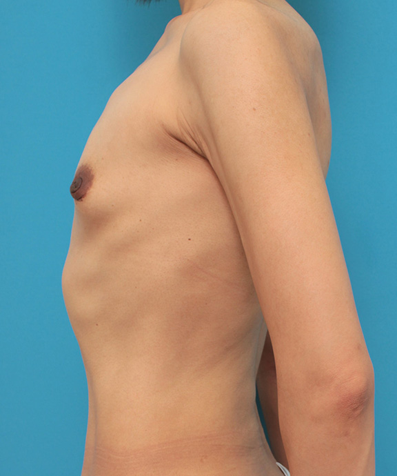豊胸手術（シリコンプロテーゼ）,非常に痩せていて鳩胸で胸が離れている30代後半の女性に大胸筋下185ccで豊胸手術を行った症例写真,Before,ba_hokyo030_b03.jpg