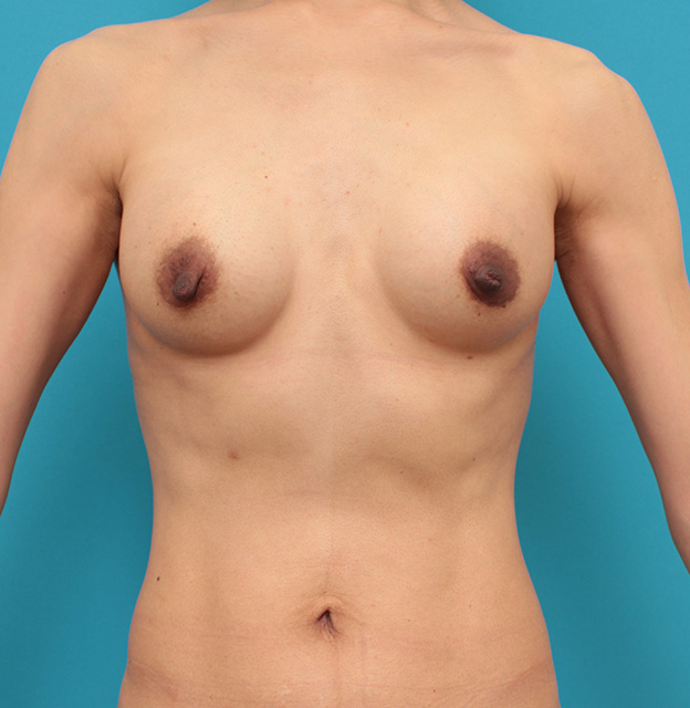豊胸手術（シリコンプロテーゼ）,非常に痩せていて鳩胸で胸が離れている30代後半の女性に大胸筋下185ccで豊胸手術を行った症例写真,6ヶ月後,mainpic_hokyo030d.jpg