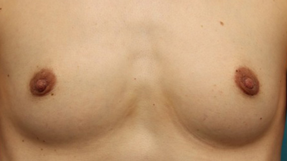 乳頭縮小,40代女性の、授乳によって伸びて垂れ下がってしまった乳頭を縮小した症例写真,After（6ヶ月後）,ba_nyuto019_a01.jpg