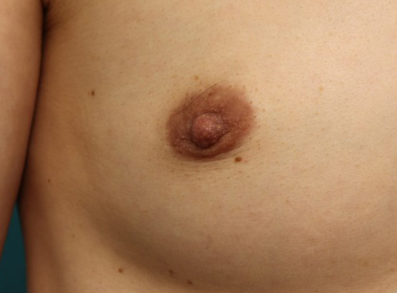 乳頭縮小,40代女性の、授乳によって伸びて垂れ下がってしまった乳頭を縮小した症例写真,After（6ヶ月後）,ba_nyuto019_b02.jpg