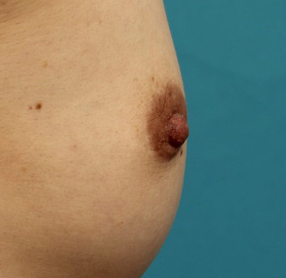 乳頭縮小,40代女性の、授乳によって伸びて垂れ下がってしまった乳頭を縮小した症例写真,After（6ヶ月後）,ba_nyuto019_b04.jpg