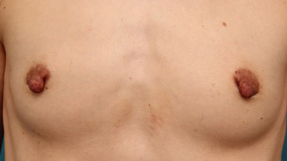 乳頭縮小,40代女性の、授乳によって伸びて垂れ下がってしまった乳頭を縮小した症例写真,Before,ba_nyuto019_b01.jpg