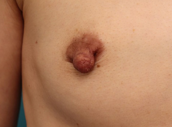 乳頭縮小,40代女性の、授乳によって伸びて垂れ下がってしまった乳頭を縮小した症例写真,Before,ba_nyuto019_b02.jpg