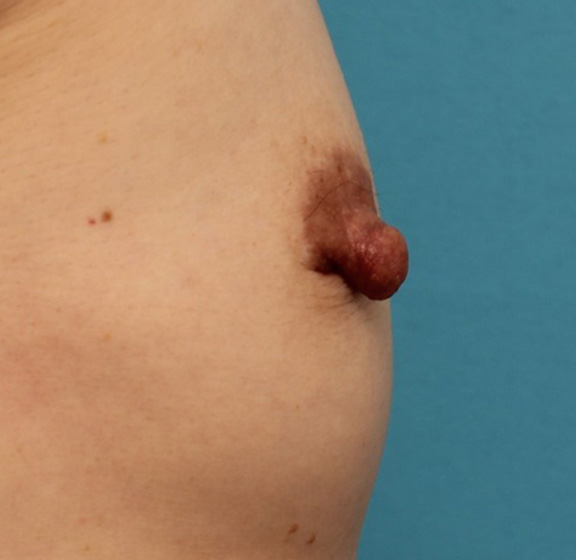 乳頭縮小,40代女性の、授乳によって伸びて垂れ下がってしまった乳頭を縮小した症例写真,Before,ba_nyuto019_b04.jpg