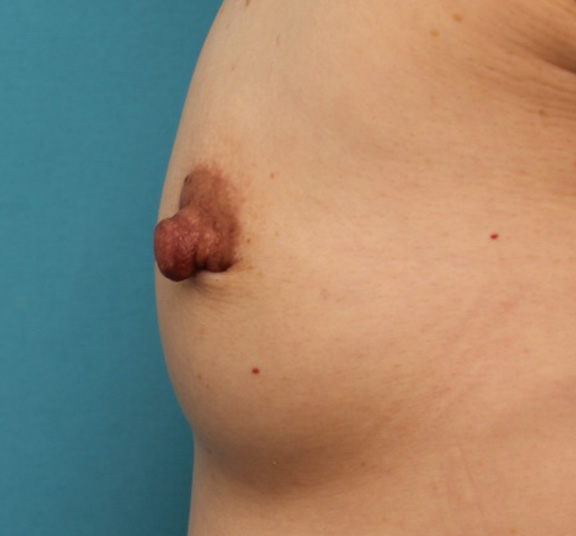 乳頭縮小,40代女性の、授乳によって伸びて垂れ下がってしまった乳頭を縮小した症例写真,Before,ba_nyuto019_b05.jpg
