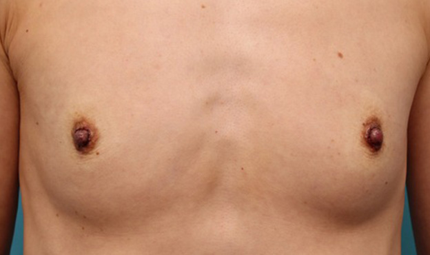 乳頭縮小,40代女性の、授乳によって伸びて垂れ下がってしまった乳頭を縮小した症例写真,手術直後,mainpic_nyuto019b.jpg