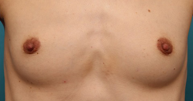 乳頭縮小,40代女性の、授乳によって伸びて垂れ下がってしまった乳頭を縮小した症例写真,1ヶ月後,mainpic_nyuto019d.jpg