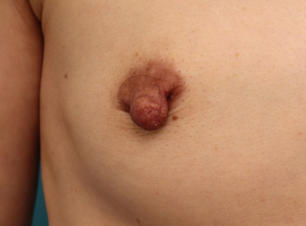 乳頭縮小,40代女性の、授乳によって伸びて垂れ下がってしまった乳頭を縮小した症例写真,手術前,mainpic_nyuto019f.jpg