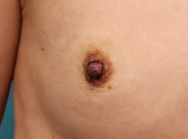 乳頭縮小,40代女性の、授乳によって伸びて垂れ下がってしまった乳頭を縮小した症例写真,手術直後,mainpic_nyuto019g.jpg