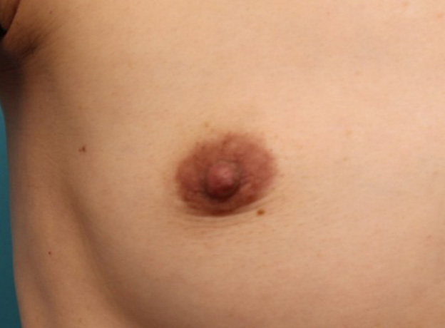乳頭縮小,40代女性の、授乳によって伸びて垂れ下がってしまった乳頭を縮小した症例写真,1ヶ月後,mainpic_nyuto019i.jpg