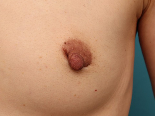 乳頭縮小,40代女性の、授乳によって伸びて垂れ下がってしまった乳頭を縮小した症例写真,手術前,mainpic_nyuto019k.jpg