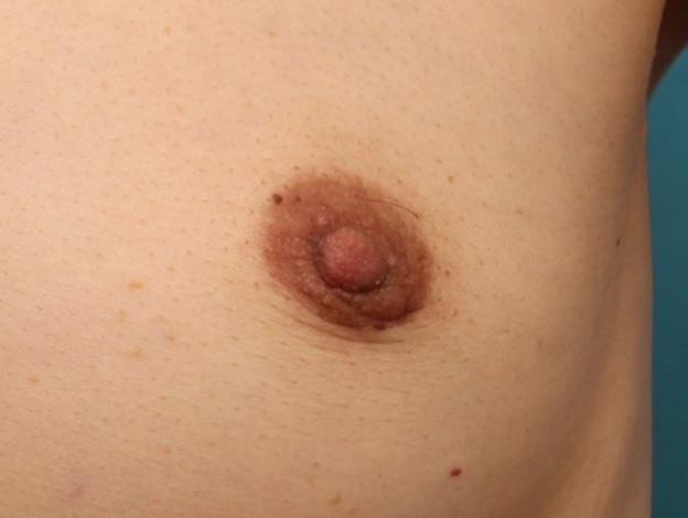 乳頭縮小,40代女性の、授乳によって伸びて垂れ下がってしまった乳頭を縮小した症例写真,1ヶ月後,mainpic_nyuto019n.jpg