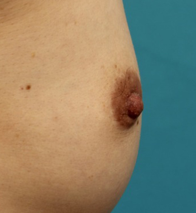 乳頭縮小,40代女性の、授乳によって伸びて垂れ下がってしまった乳頭を縮小した症例写真,6ヶ月後,mainpic_nyuto019r.jpg