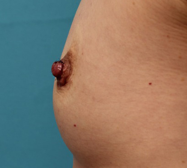 乳頭縮小,40代女性の、授乳によって伸びて垂れ下がってしまった乳頭を縮小した症例写真,手術直後,mainpic_nyuto019t.jpg