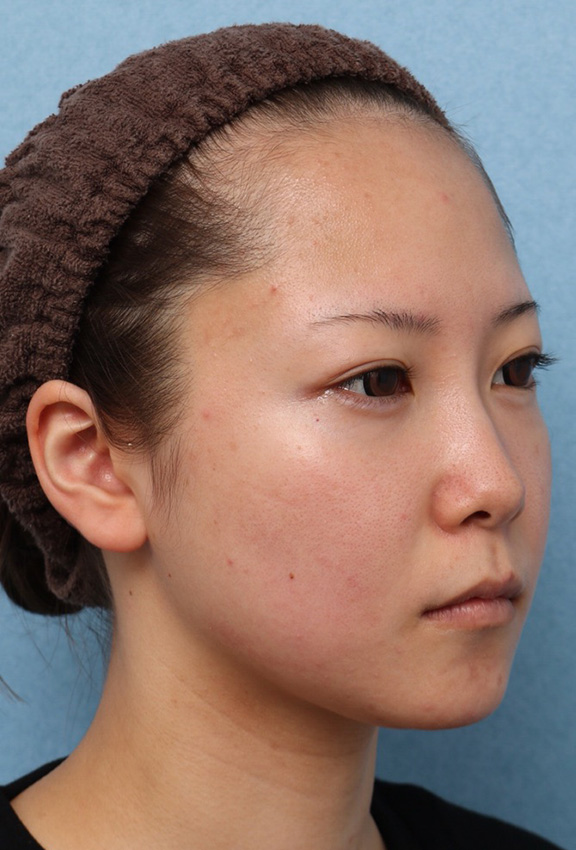 小顔専用脂肪溶解注射メソシェイプフェイス,ウルセラと顔の脂肪溶解注射のコンビネーションで2ヶ月で頬がホッソリした症例写真,Before,ba_ulthera030_b02.jpg
