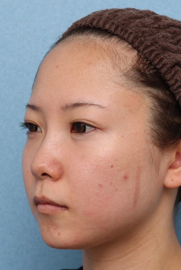 小顔専用脂肪溶解注射メソシェイプフェイス,ウルセラと顔の脂肪溶解注射のコンビネーションで2ヶ月で頬がホッソリした症例写真,Before,ba_ulthera030_b03.jpg