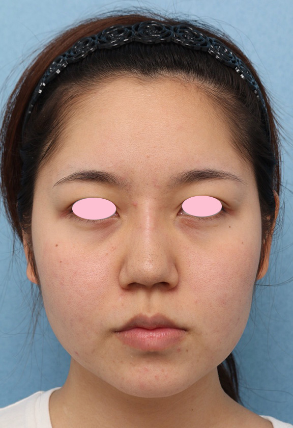 隆鼻注射（ヒアルロン酸注射）,隆鼻ヒアルロン酸注射の症例写真,After（直後）,ba_ryubi2032_b01.jpg
