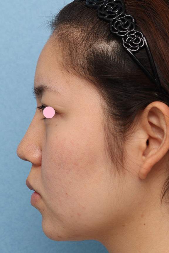 隆鼻注射（ヒアルロン酸注射）,隆鼻ヒアルロン酸注射の症例写真,After（直後）,ba_ryubi2032_b02.jpg