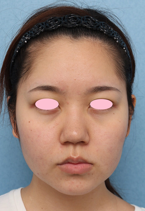 隆鼻注射（ヒアルロン酸注射）,隆鼻ヒアルロン酸注射の症例写真,Before,ba_ryubi2032_b01.jpg
