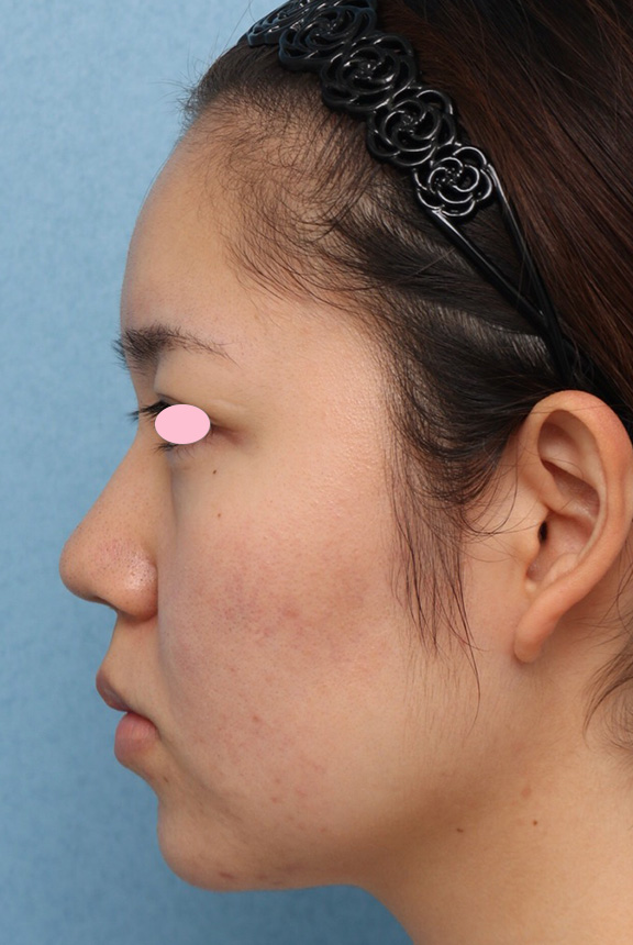 隆鼻注射（ヒアルロン酸注射）,隆鼻ヒアルロン酸注射の症例写真,Before,ba_ryubi2032_b02.jpg