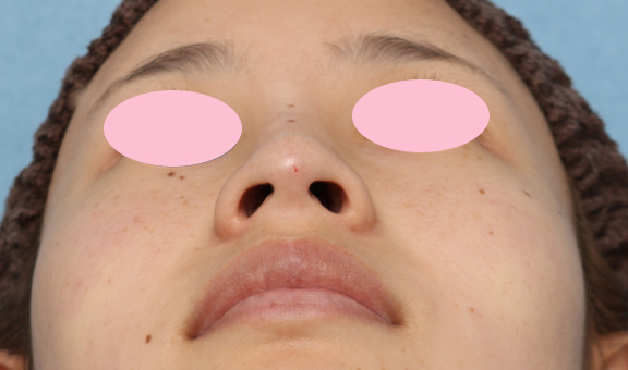 隆鼻注射（ヒアルロン酸注射）,鼻のヒアルロン酸注射の症例写真,After,ba_ryubi2034_b02.jpg