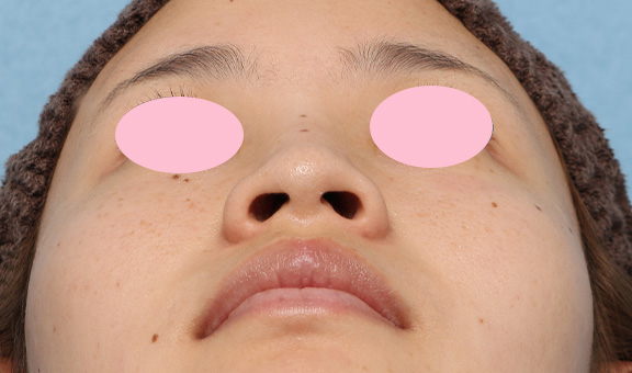 隆鼻注射（ヒアルロン酸注射）,鼻のヒアルロン酸注射の症例写真,Before,ba_ryubi2034_b02.jpg