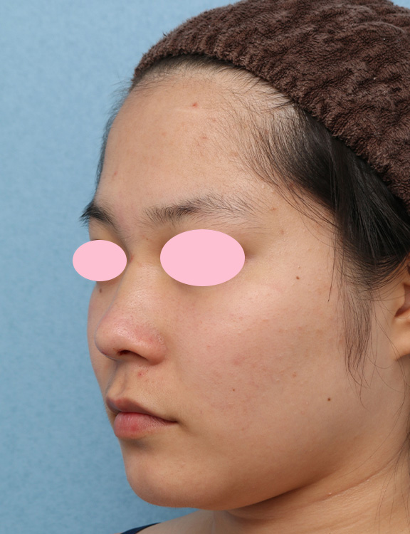 隆鼻注射（ヒアルロン酸注射）,鼻を高くするヒアルロン酸注射の症例写真,After,ba_ryubi2035_b01.jpg