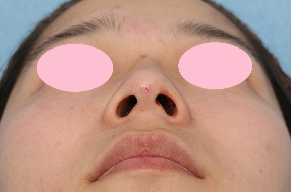 隆鼻注射（ヒアルロン酸注射）,鼻を高くするヒアルロン酸注射の症例写真,After,ba_ryubi2035_b02.jpg